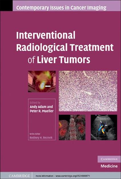 Interventional Radiological Treatment of Liver Tumors