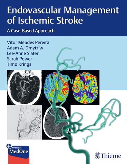 Endovascular Management of Ischemic Stroke