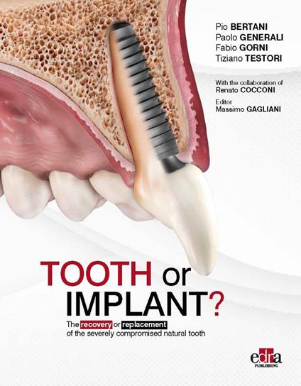 Tooth or Implant? The recovery or replacement of the severely compormised natural tooth - Pio Bertani,Paolo Generali,Fabio Gorni - copertina
