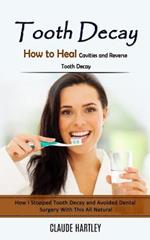 Tooth Decay: How to Heal Cavities and Reverse Tooth Decay (How I Stopped Tooth Decay and Avoided Dental Surgery With This All Natural)