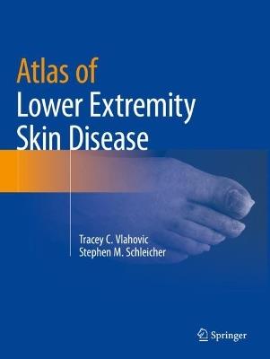 Atlas of Lower Extremity Skin Disease - Tracey C. Vlahovic,Stephen M. Schleicher - cover