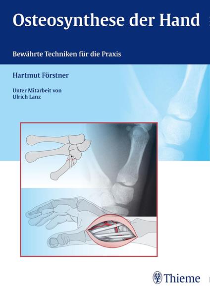 Osteosynthese der Hand - Hartmut Förstner - ebook