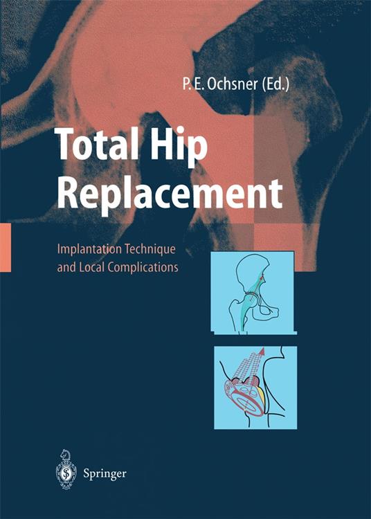 Total Hip Replacement