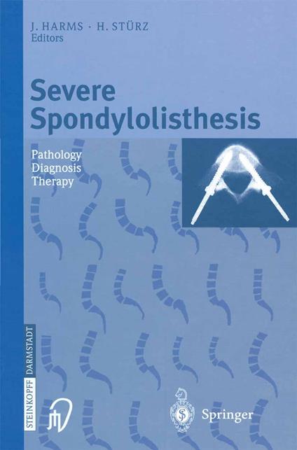 Severe Spondylolisthesis