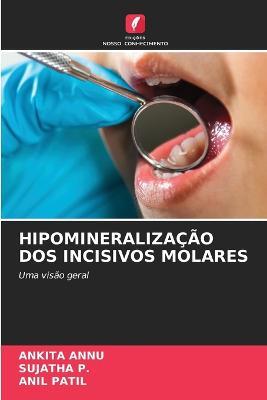 Hipomineralizacao DOS Incisivos Molares - Ankita Annu,Sujatha P,Patil - cover