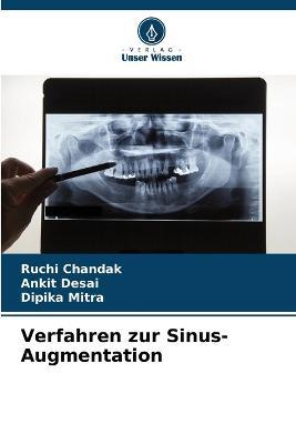 Verfahren zur Sinus-Augmentation - Ruchi Chandak,Ankit Desai,Dipika Mitra - cover