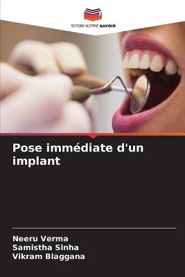 Pose immédiate d'un implant - Neeru Verma,Samistha Sinha,Vikram Blaggana - cover