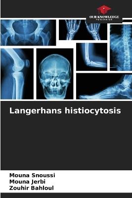 Langerhans histiocytosis - Mouna Snoussi,Mouna Jerbi,Zouhir Bahloul - cover