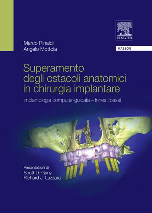 Superamento degli ostacoli anatomici in chirurgia implantare. Implantologia computer-guidata innesti ossei - Angelo Mottola,Marco Rinaldi - ebook