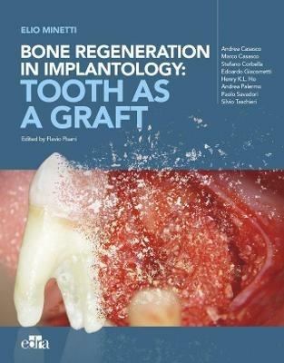 Bone regeneration in implantology: tooth as a graft - Elio Minetti - copertina