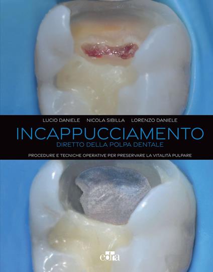 Incappucciamento diretto della polpa dentale. Procedure e tecniche operative per preservare la vitalità pulpare - Lorenzo Daniele,Lucio Daniele,Nicola Sibilla - ebook