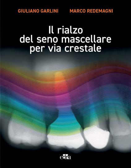 Il rialzo del seno mascellare per via crestale - Giuliano Garlini,Marco Redemagni - ebook