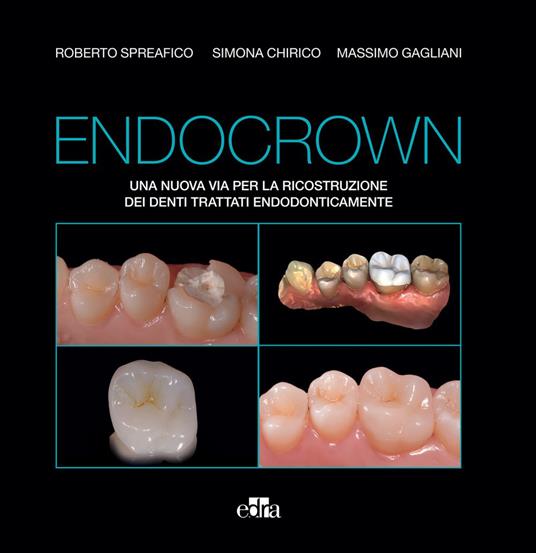 Endocrown. Una nuova via per la ricostruzione dei denti trattati endodonticamente - Simona Chirico,Massimo Gagliani,Roberto Spreafico - ebook