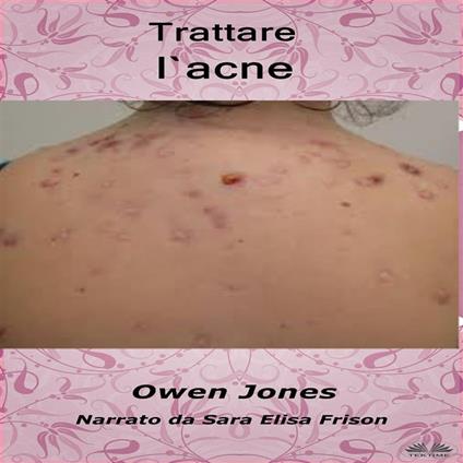 Trattare L'Acne