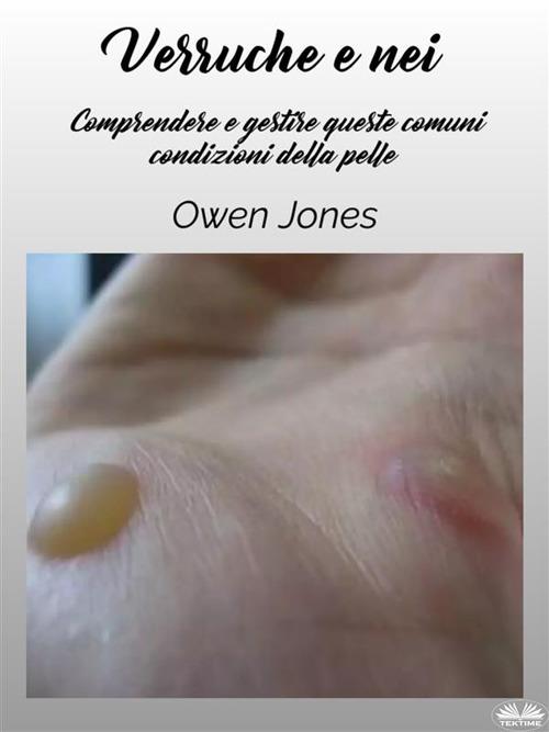 Verruche e nei. Comprendere e gestire queste comuni condizioni della pelle - Owen Jones,Elisiana Galfrè - ebook