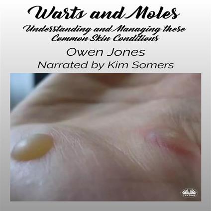 Warts And Moles