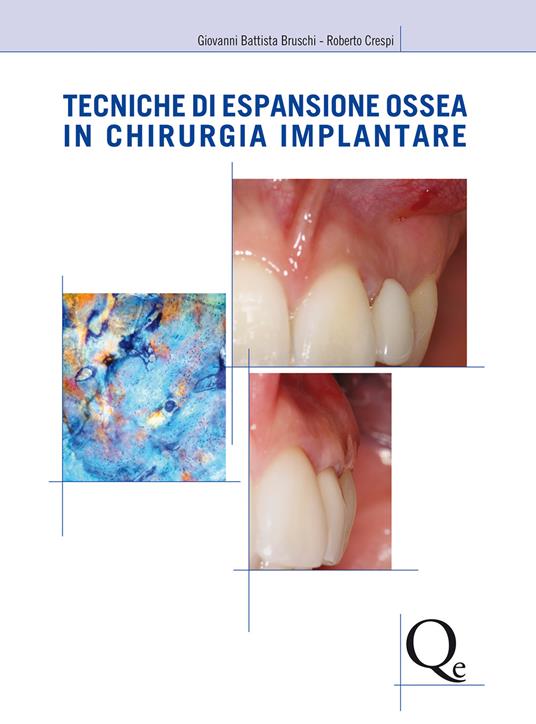 Tecniche di espansione ossea in chirurgia implantare - Giovanni Battista Bruschi,Roberto Crespi - copertina