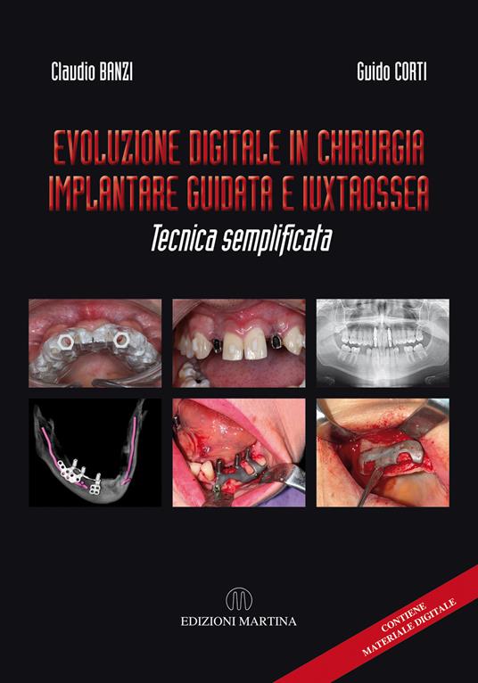 Evoluzione digitale in chirurgia implantare guidata e iuxtaossea. Tecnica semplificata. Ediz. italiana e inglese. Con QR Code - Claudio Banzi,Guido Corti - copertina