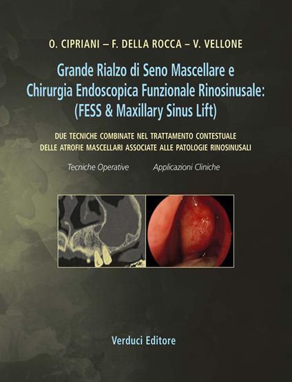 Grande rialzo di seno mascellare e chirurgia endoscopica funzionale rinosinusale. Due tecniche combinate nel trattamento contestuale delle atrofie mascellari associate alle patologie rinosinusali - copertina