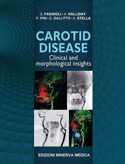 Carotid disease. Clinical and morphological insights - Gianluca Faggioli,Alison Halliday,Rodolfo Pini - copertina