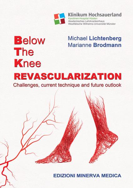 Below the knee revascularization. Challenges, current technique and future outlook - Michael Lichtenberg,Marianne Brodmann - copertina