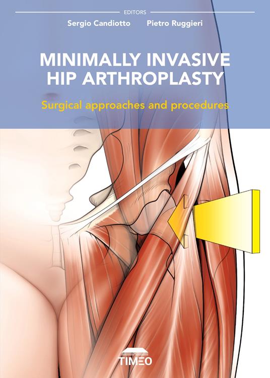 Minimally invasive hip arthroplasty. Surgical approaches and procedures - Sergio Candiotto,Pietro Ruggieri - copertina