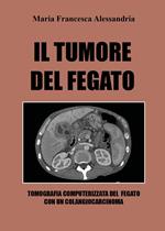 Il tumore del fegato