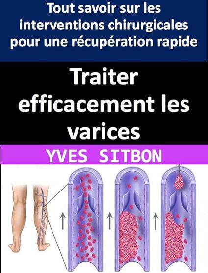 Traiter efficacement les varices : Tout savoir sur les interventions chirurgicales pour une récupération rapide