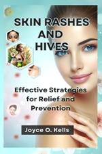 Skin Rashes and Hives: Effective Strategies for Relief and Prevention