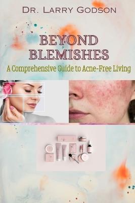 Beyond Blemishes: A Comprehensive Guide to Acne-Free Living/ Skincare Bible for Radiant Skin - Larry Godson - cover